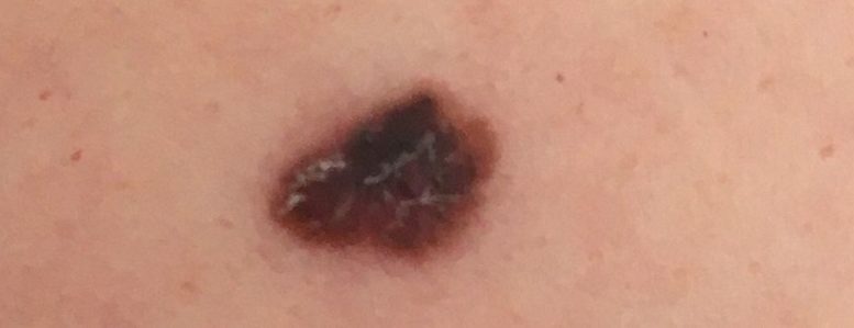imagem aproximada de um melanoma, uma pinta escura e irregular em uma pele clara