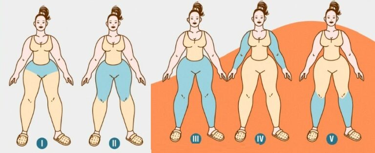 desenho de cinco mulheres com lipedema