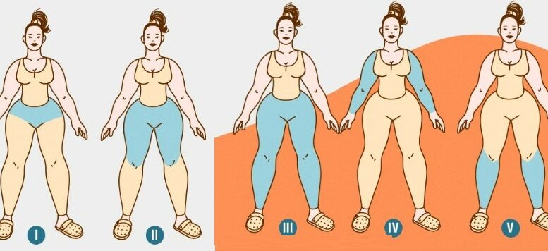 desenho de cinco mulheres com lipedema